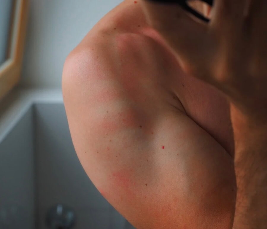 Sonnenbrand am Arm eines Mannes